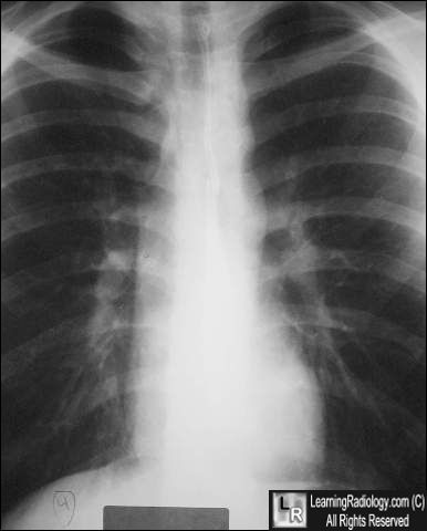 Coarctation-figure3 sign